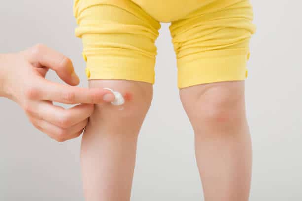 A close-up of an adult hand applying ointment to a small scrape on a child's knee. The child is wearing yellow shorts.