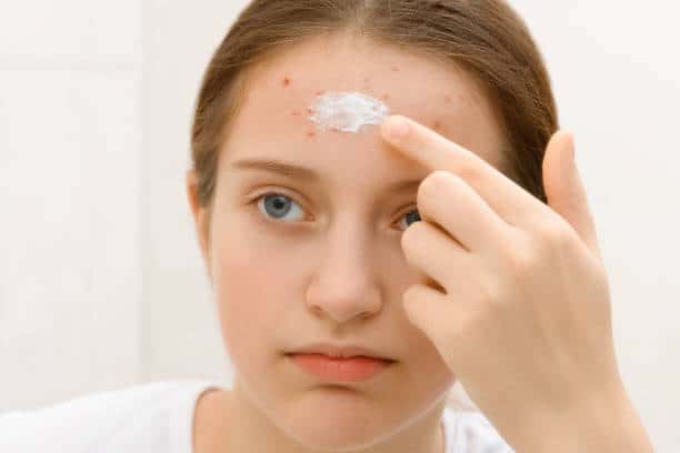 A young person applies cream to acne on the forehead.