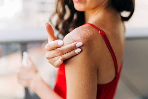 A person in a red top applies lotion to their shoulder with peeling skin.