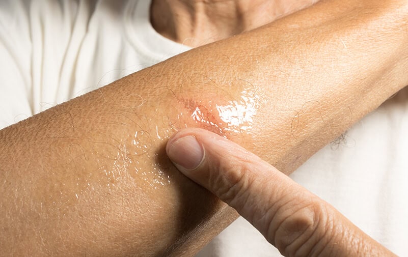 Close-up of a person applying ointment to a healing wound on their arm with their thumb. The skin is slightly red and moist.